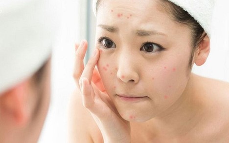tất tần tật về mụn trứng cá