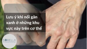 Lưu ý khi nổi gân xanh ở những khu vực này trên cơ thể
