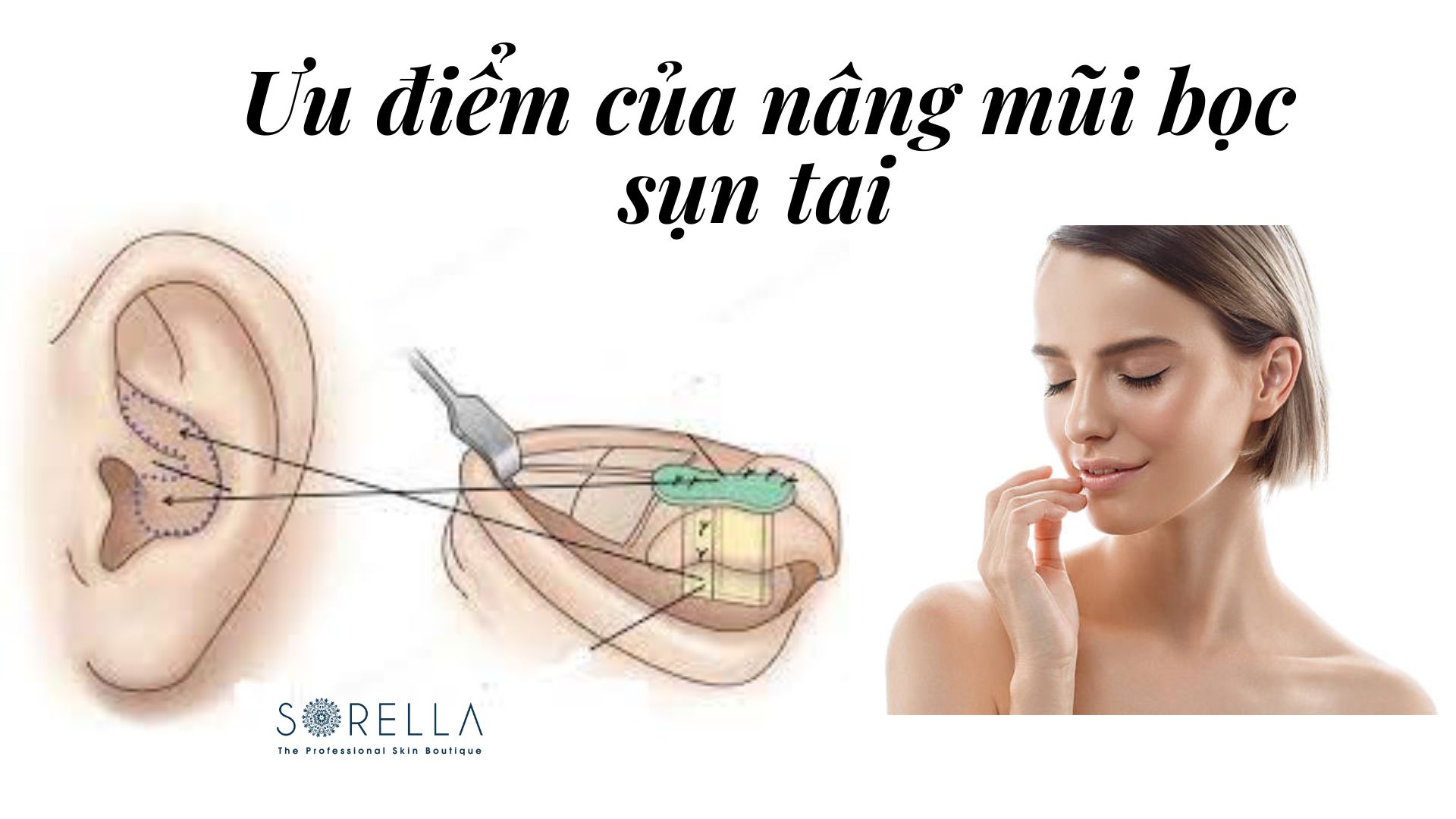 Nâng mũi bọc sụn tai là gì?