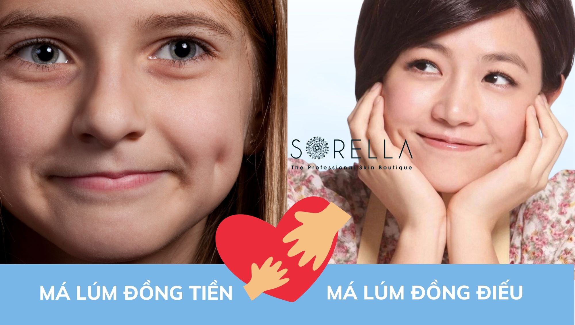 má lúm đồng điếu