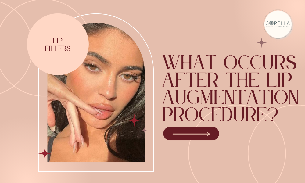 What are lip fillers?