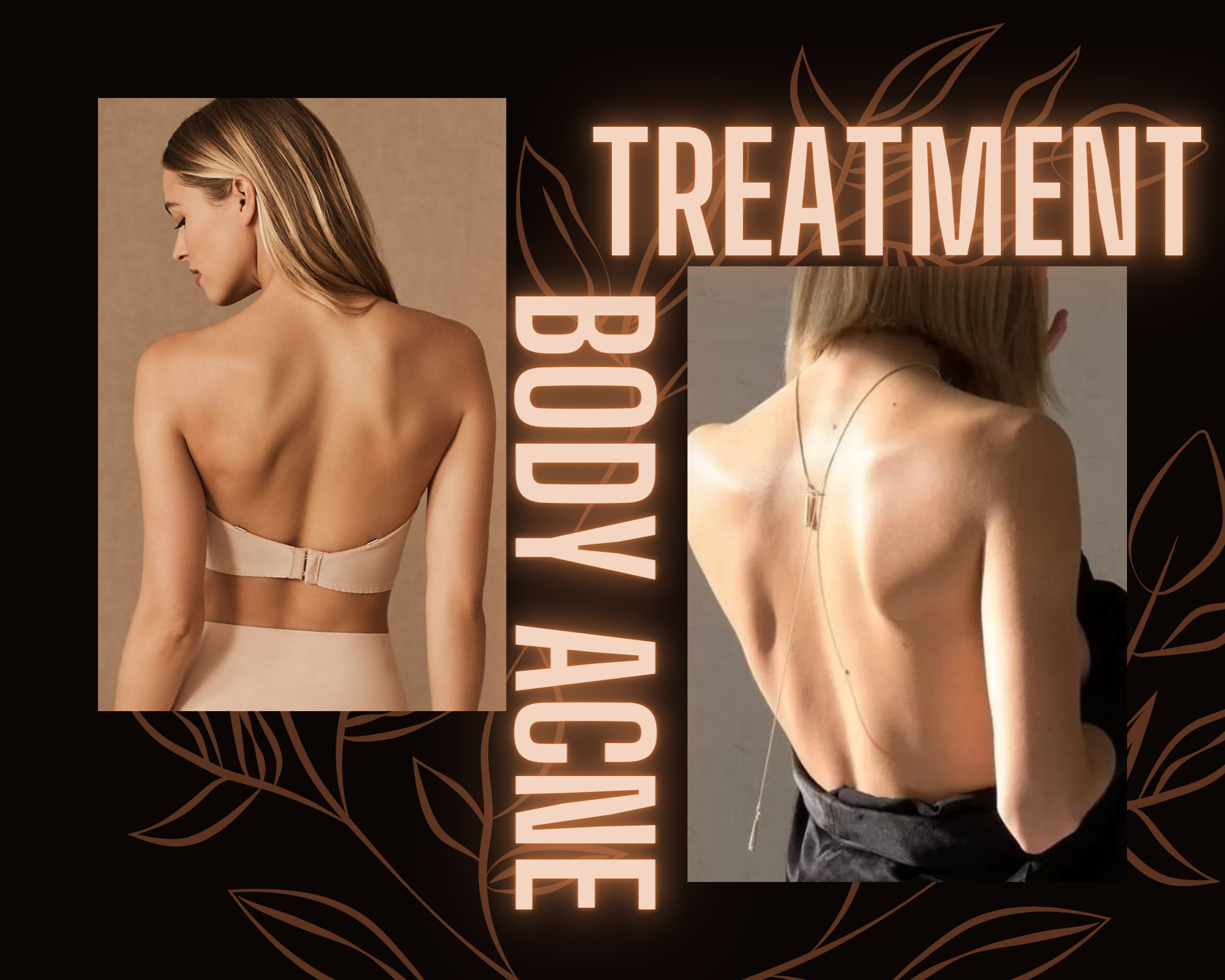 Treatment for Back and Body Acne