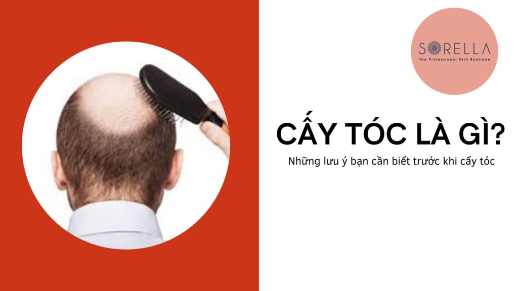 Những lưu ý bạn cần biết trước khi cấy tóc