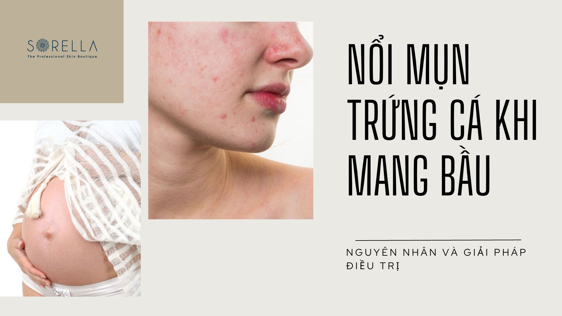 Nổi mụn khi mang bầu 