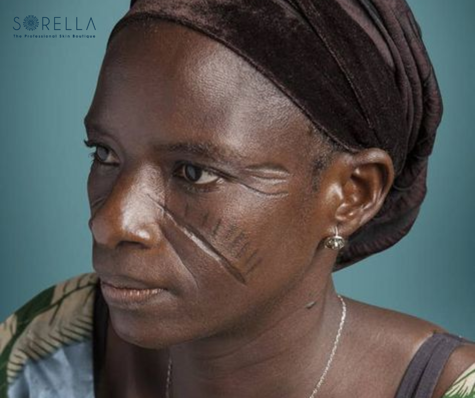 Laser therapy or pulsed dye laser has been shown in studies to be beneficial for scar treatment patients