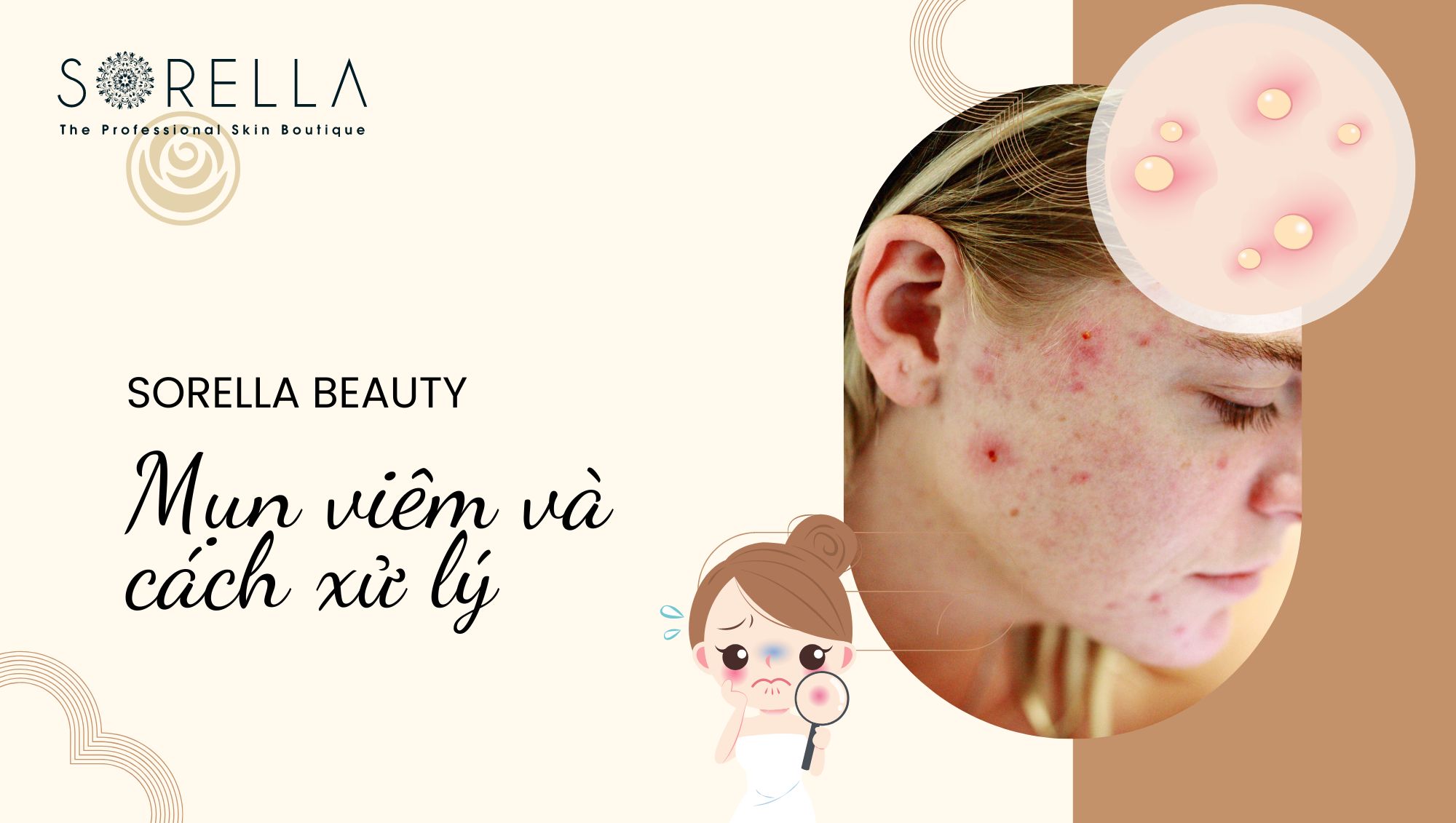 Mụn viêm là gì?
