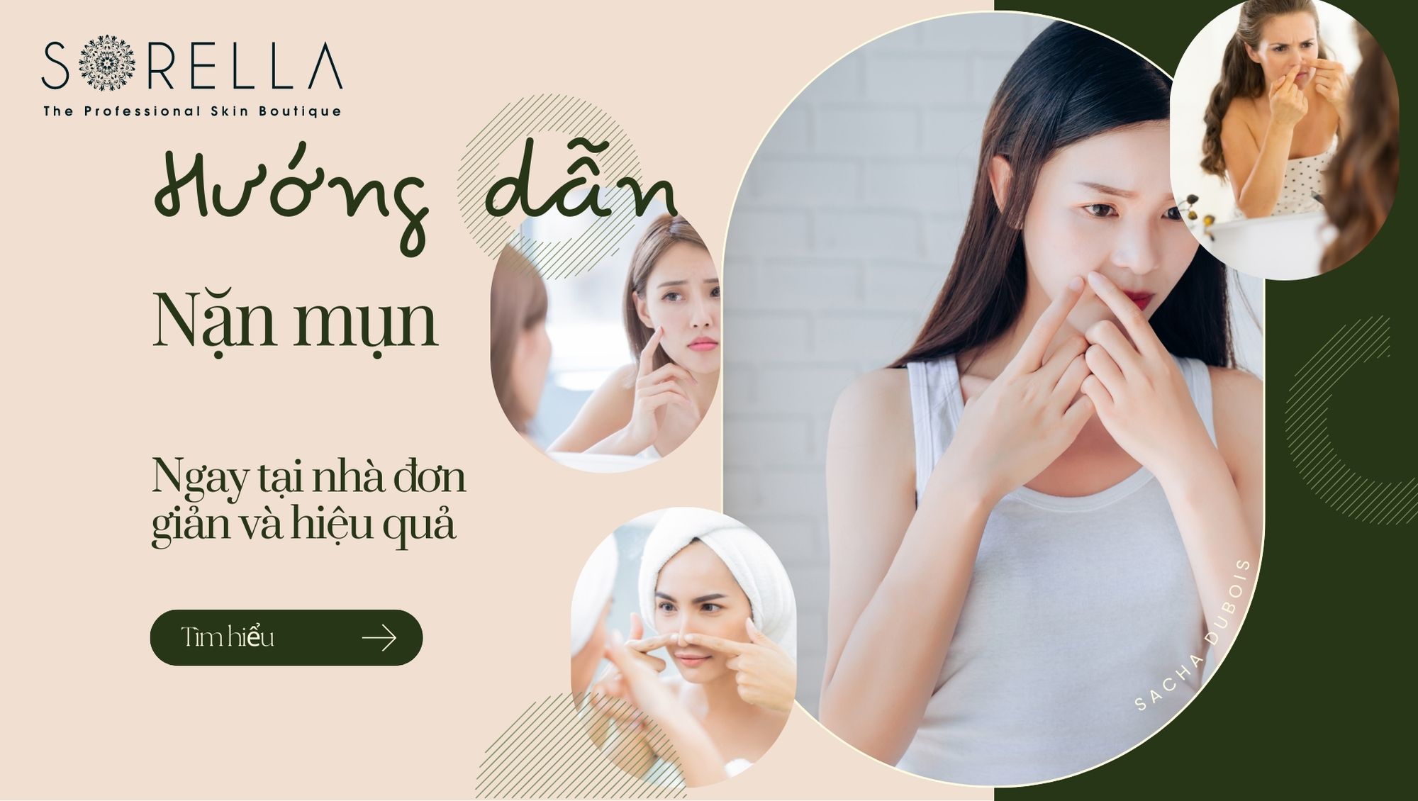 Cách nặn mụn tại nhà