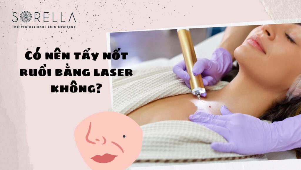 tẩy nốt ruồi bằng laser