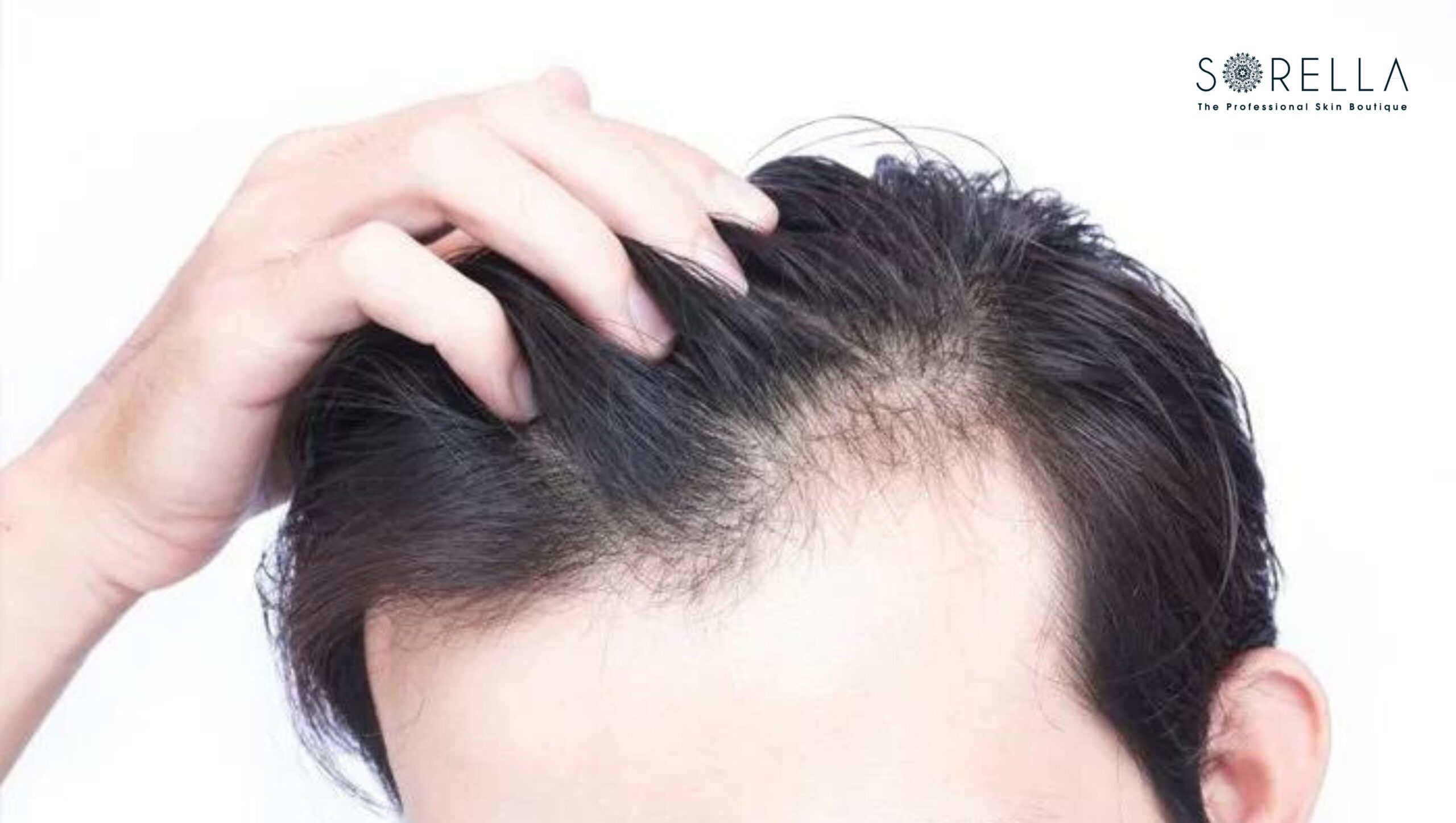 Nam giới bị hói tóc khá nhiều