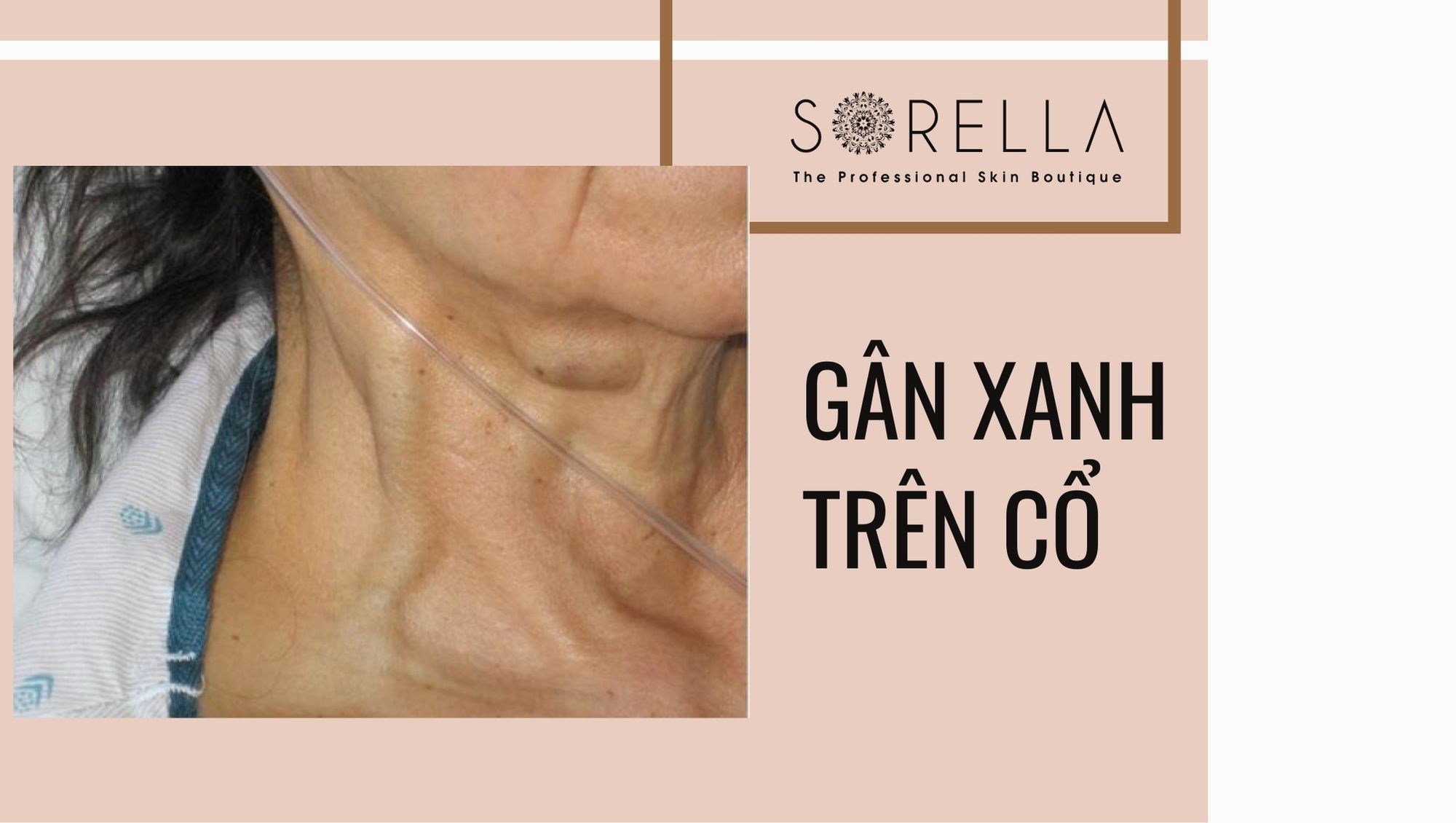 nổi gân xanh