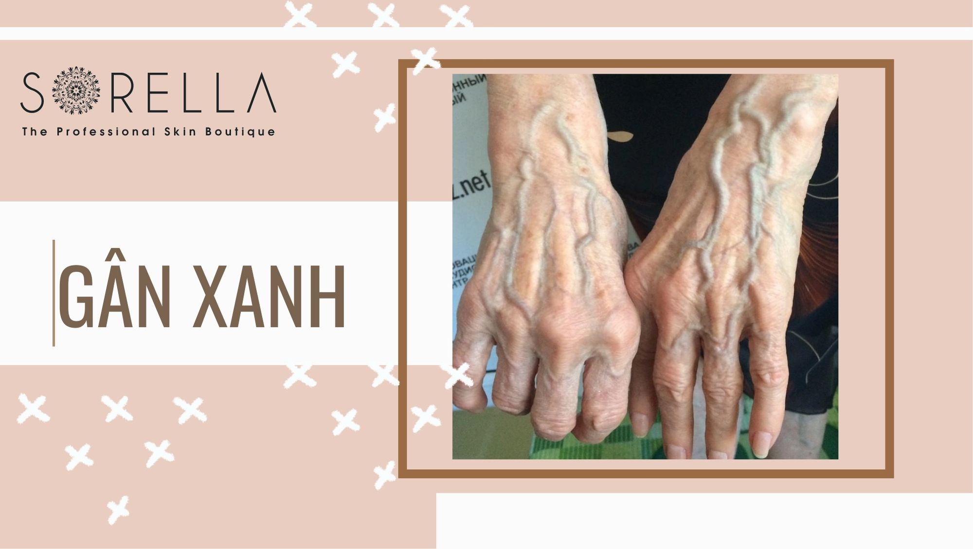 Tình trạng nổi gân xanh