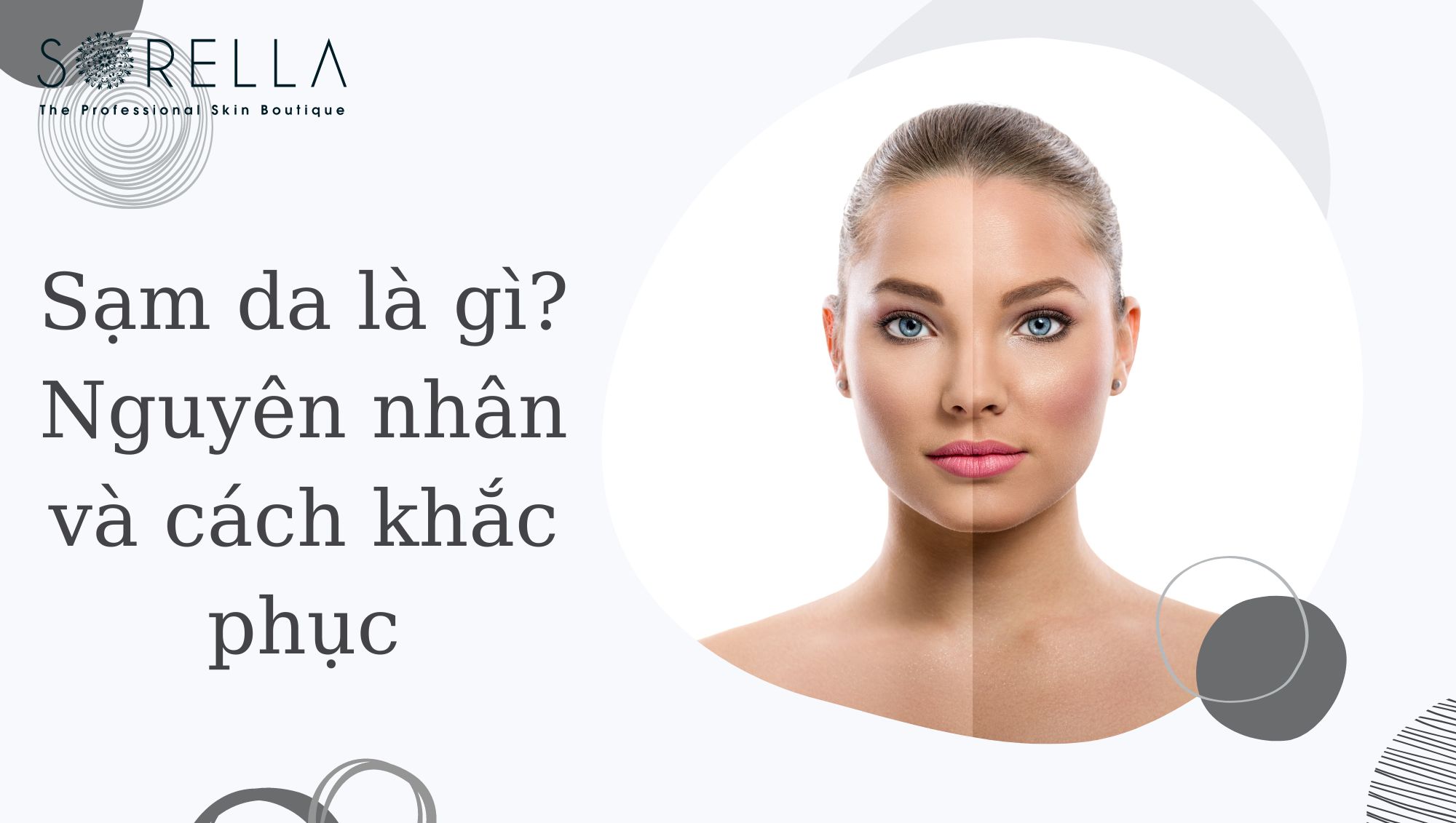 Sạm da là gì?