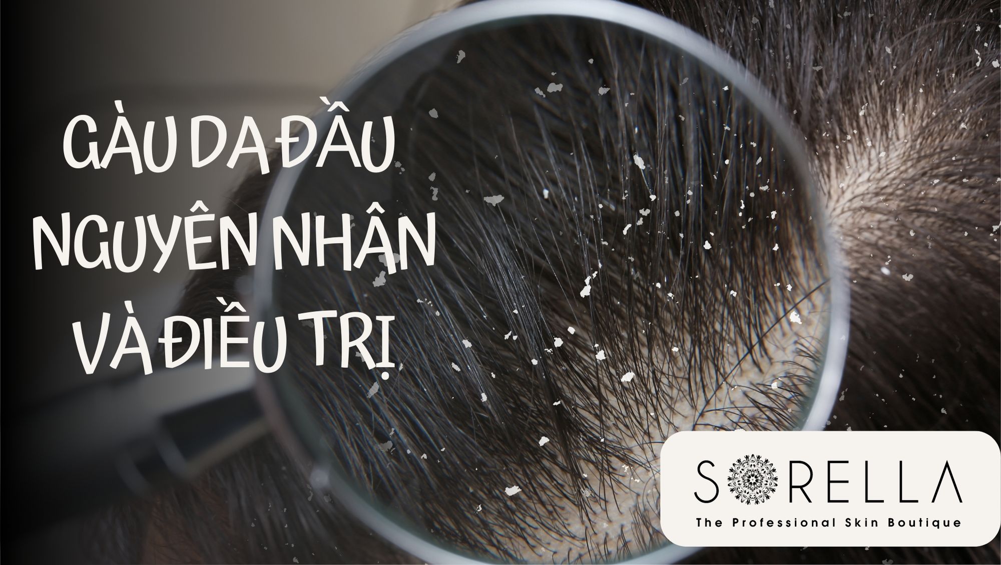 gàu da đầu