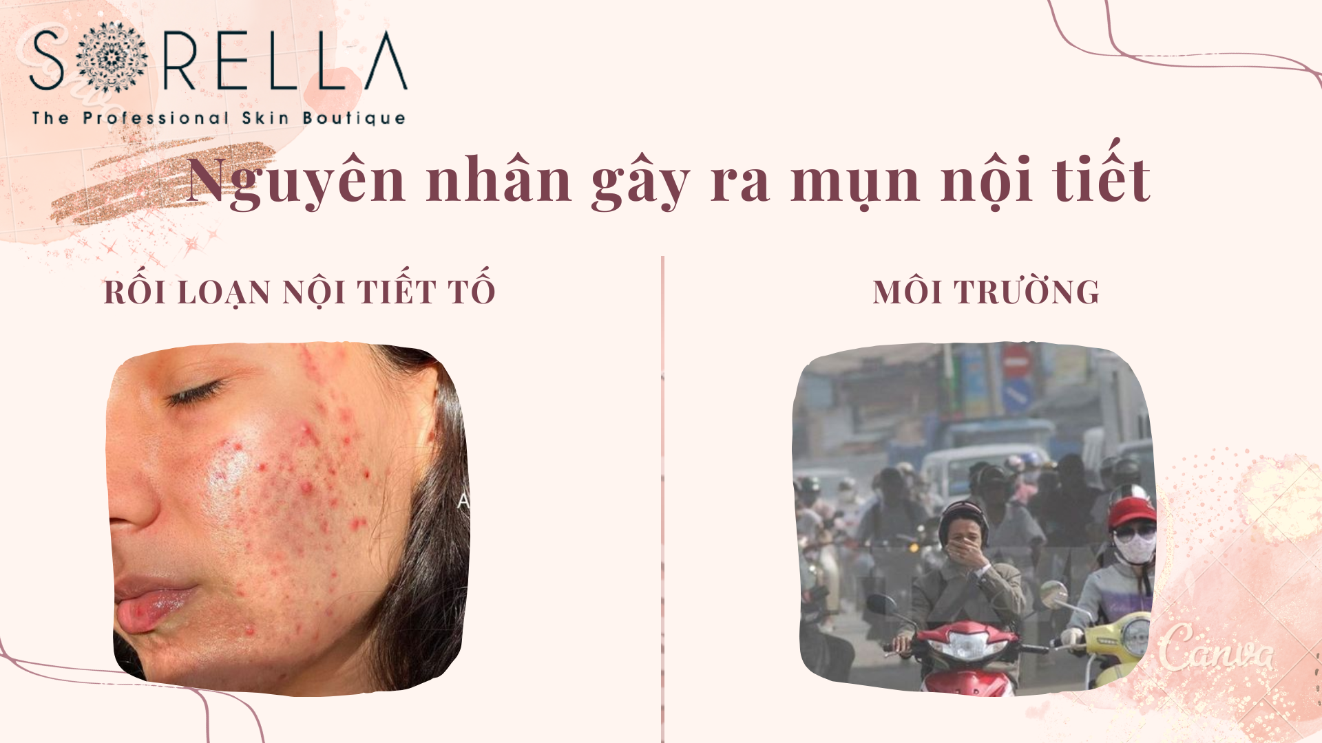 Nguyên nhân gây ra mụn nội tiết