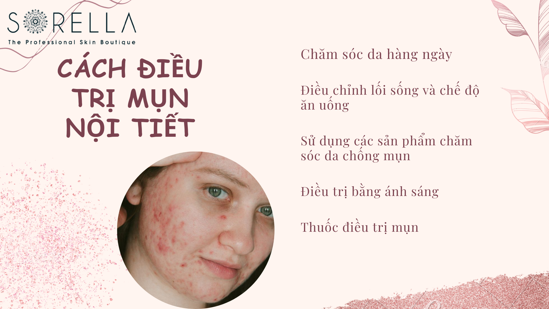 Cách điều trị mụn nội tiết