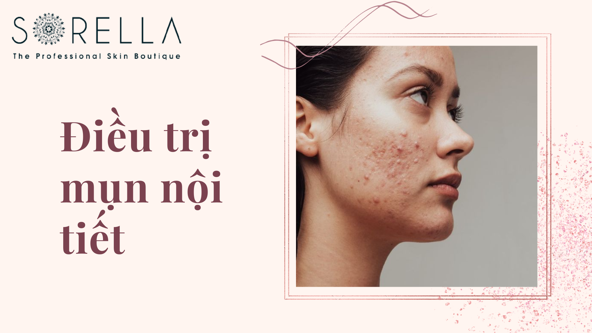 Điều trị mụn nội tiết