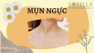 Mụn ngực