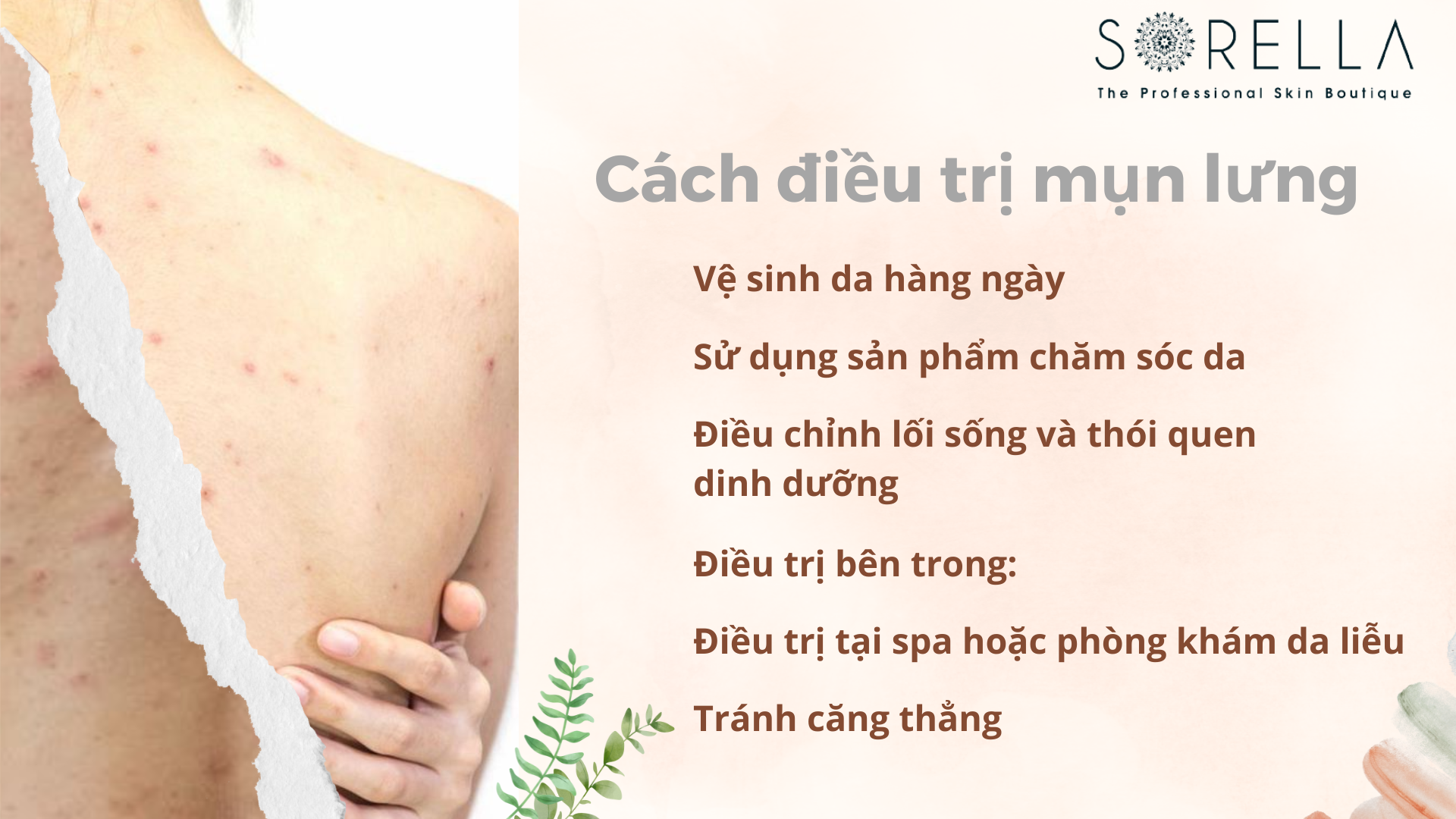 Cách điều trị mụn lưng