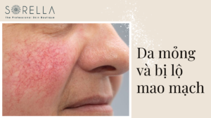 Da mỏng và bị lộ mao mạch