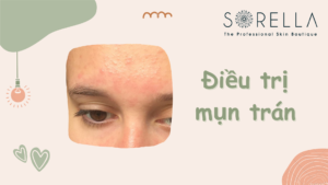 Điều trị mụn trán