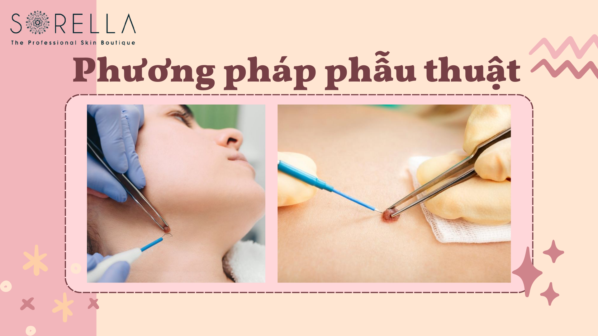 Tẩy nốt ruồi bằng phẫu thuật