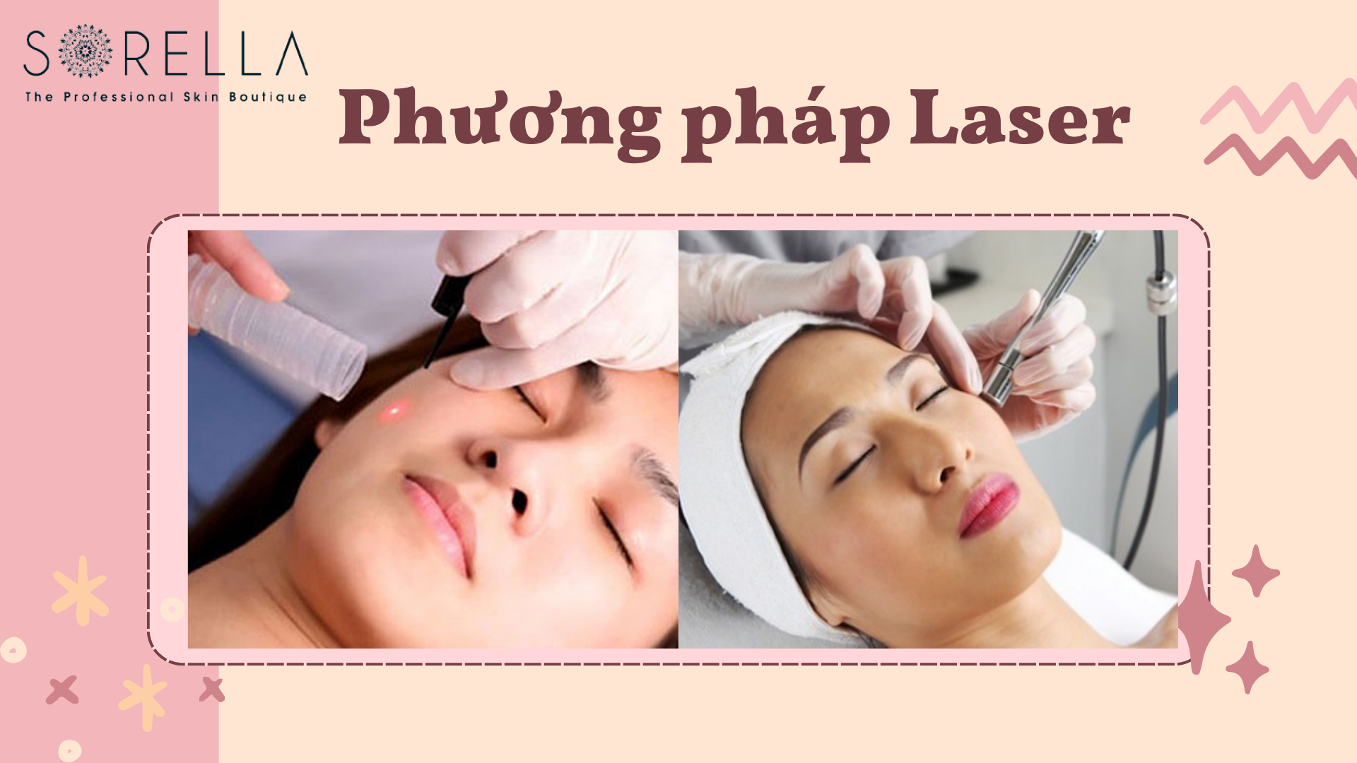 Tẩy nốt ruồi bằng laser