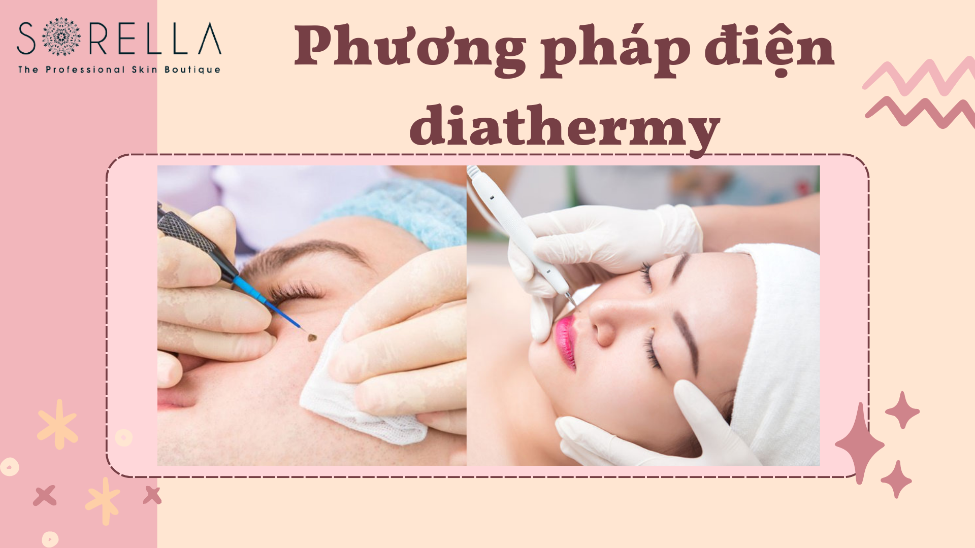 Tẩy nốt ruồi bằng điện diathermy