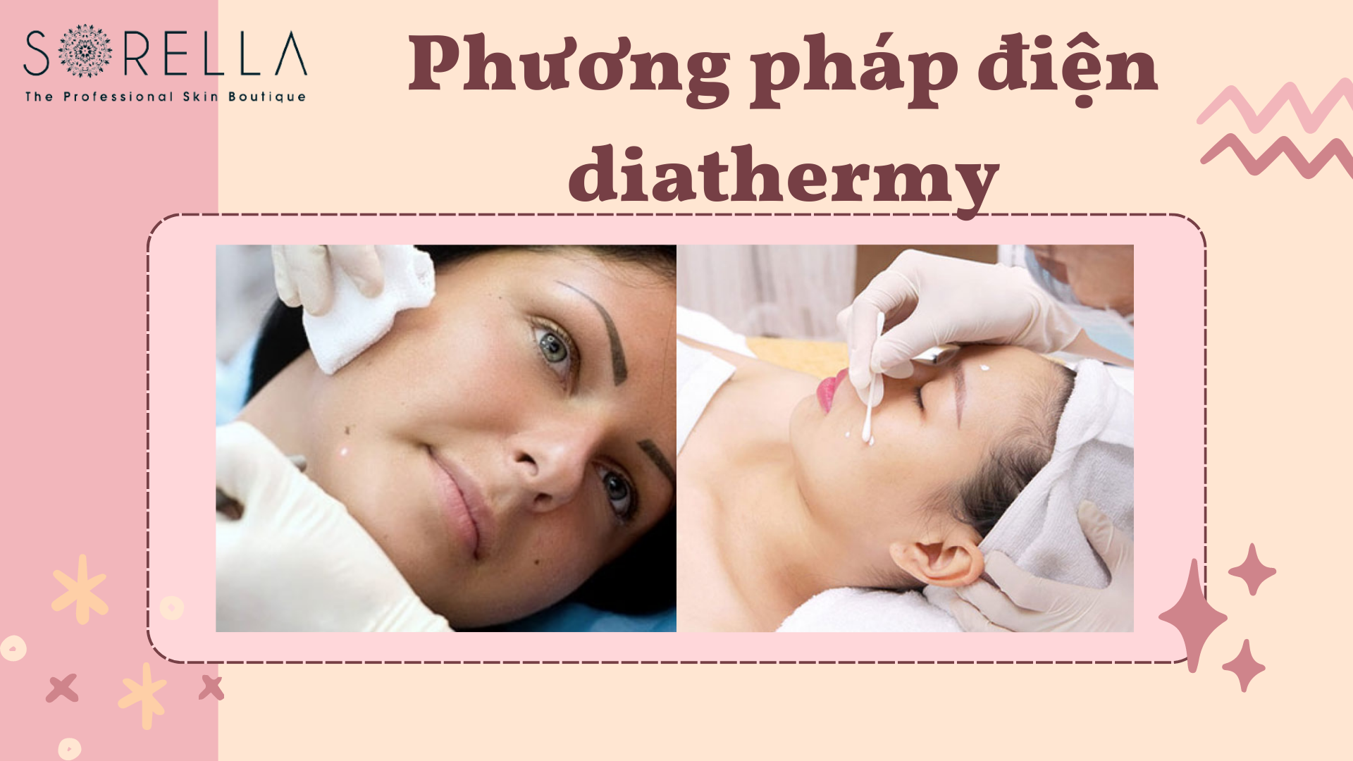Tẩy nốt ruồi bằng cryotherapy