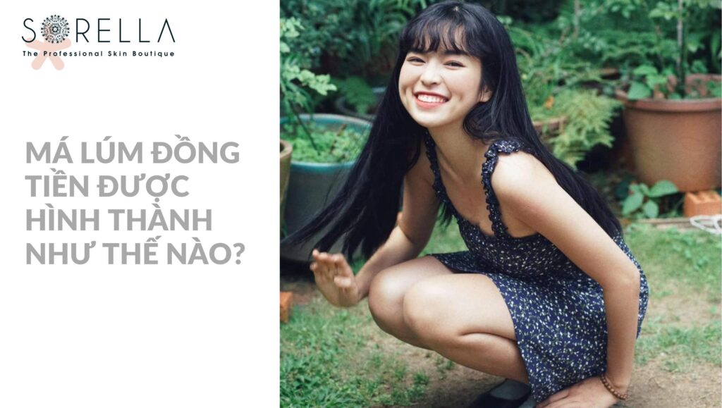 của má lúm đồng tiền