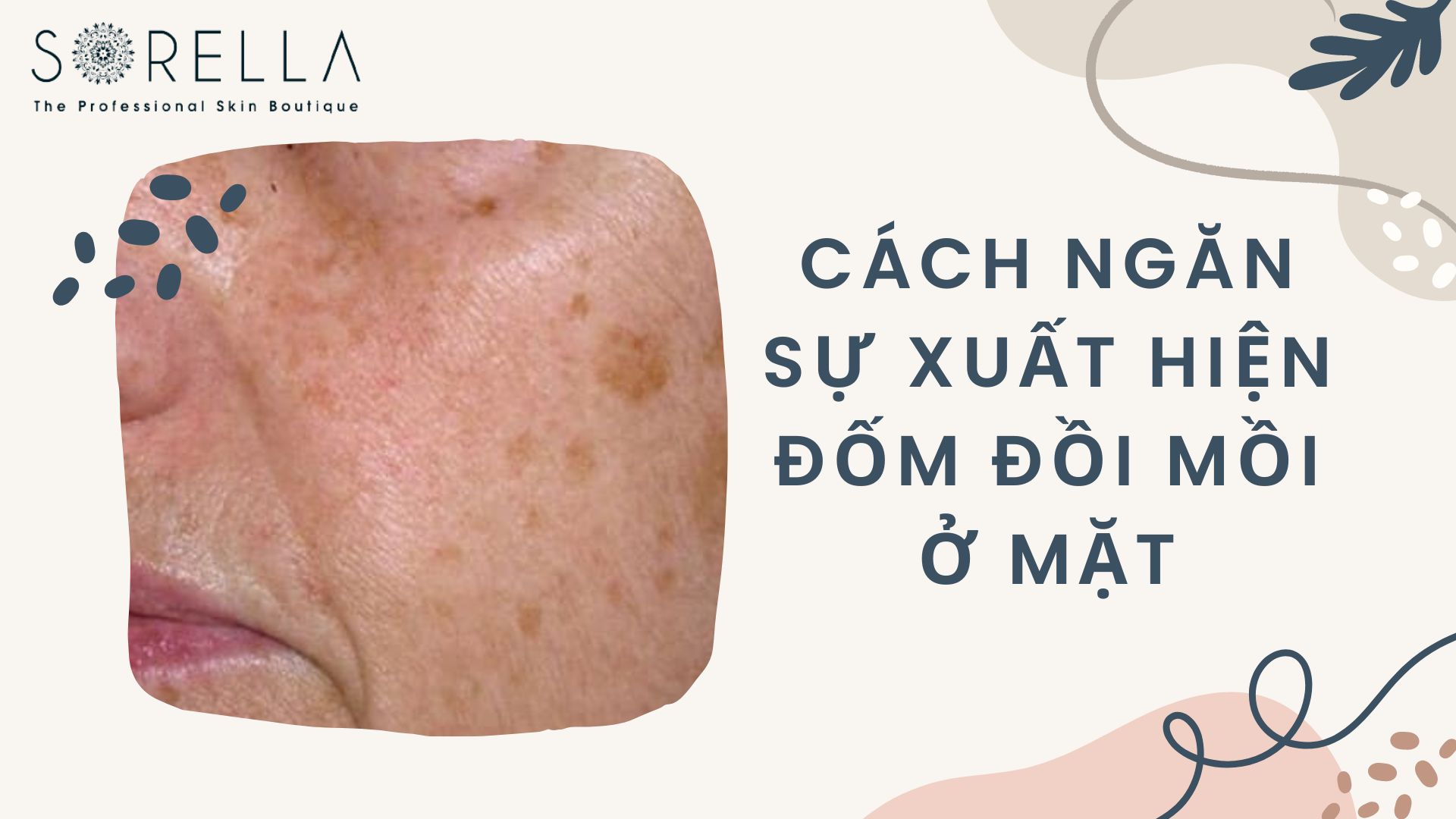 Cách ngăn sự xuất hiện đốm đồi mồi ở mặt