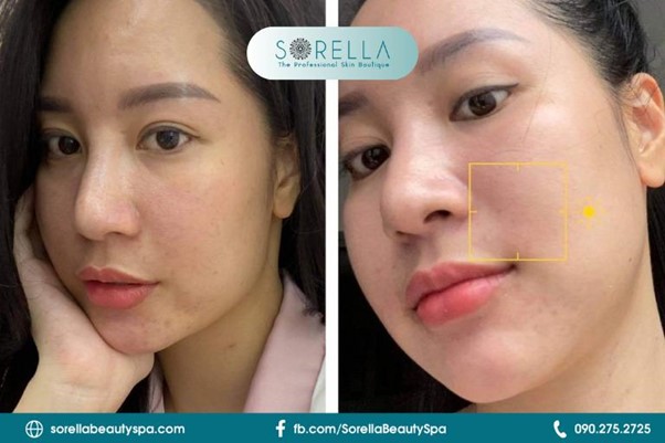 Tăng cường hydrat và bổ sung các dưỡng chất 