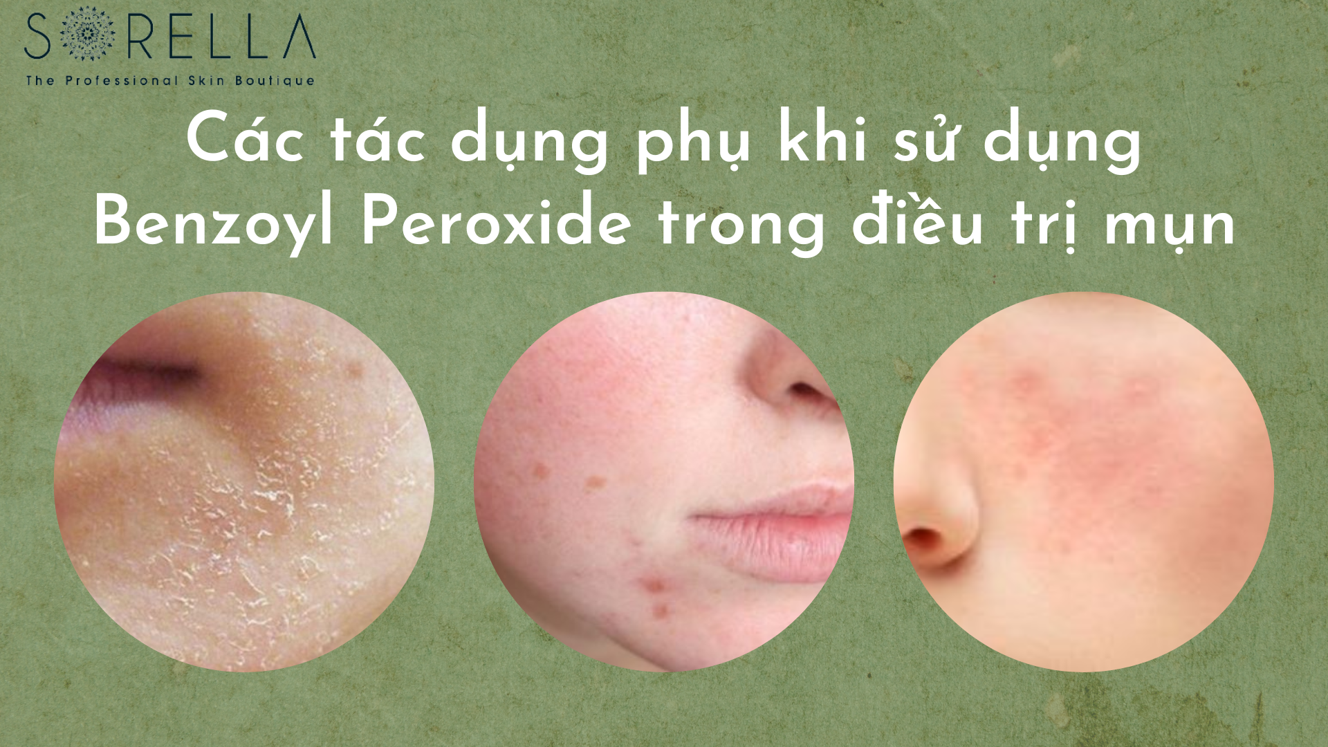 Các tác dụng phụ mà bạn có thể gặp phải khi sử dụng Benzoyl Peroxide trong điều trị mụn