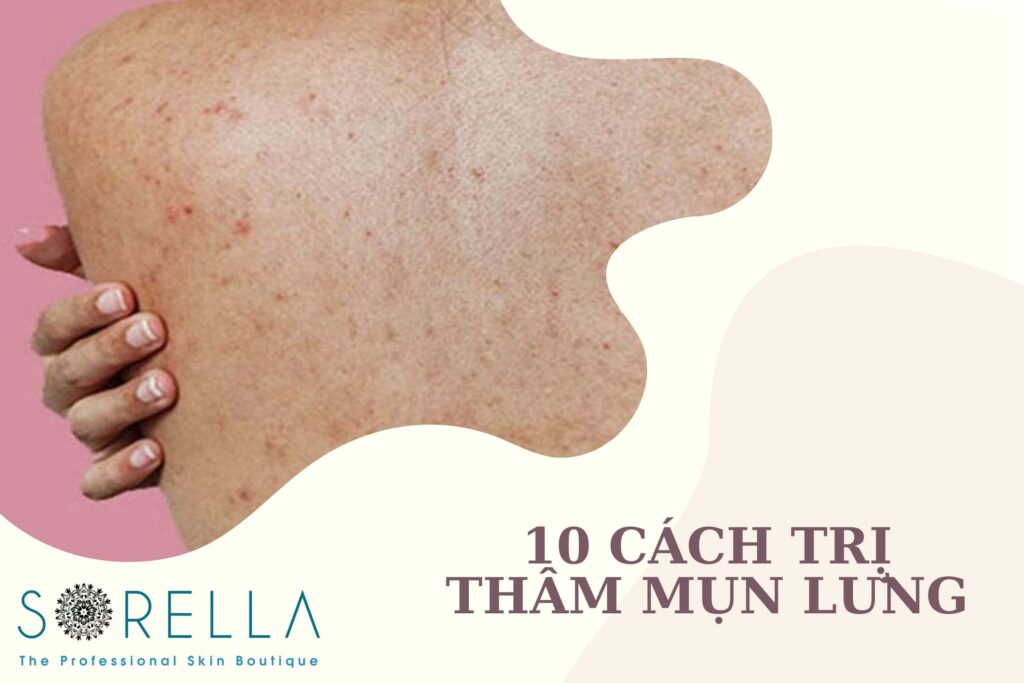 https://new.sorellabeautyspa.com/?p=9104&preview=true thâm mụn lưng