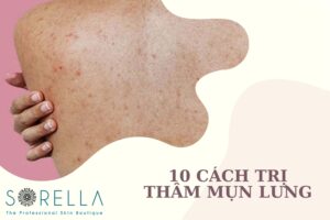 https://new.sorellabeautyspa.com/?p=9104&preview=true thâm mụn lưng