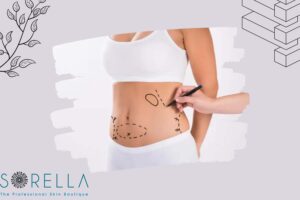 https://new.sorellabeautyspa.com/hut-mo-bung-va-6-dieu-can-luu-y.html hút mỡ bụng