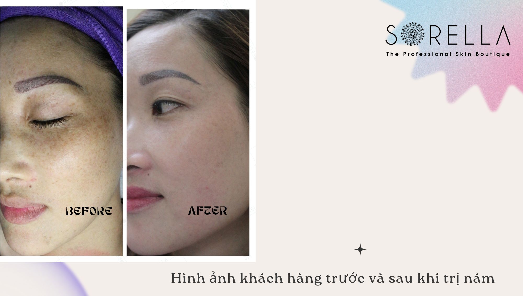 Phác đồ điều trị nám da
