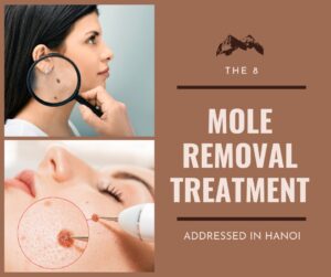 Mole removal treatment addressed in Hanoi