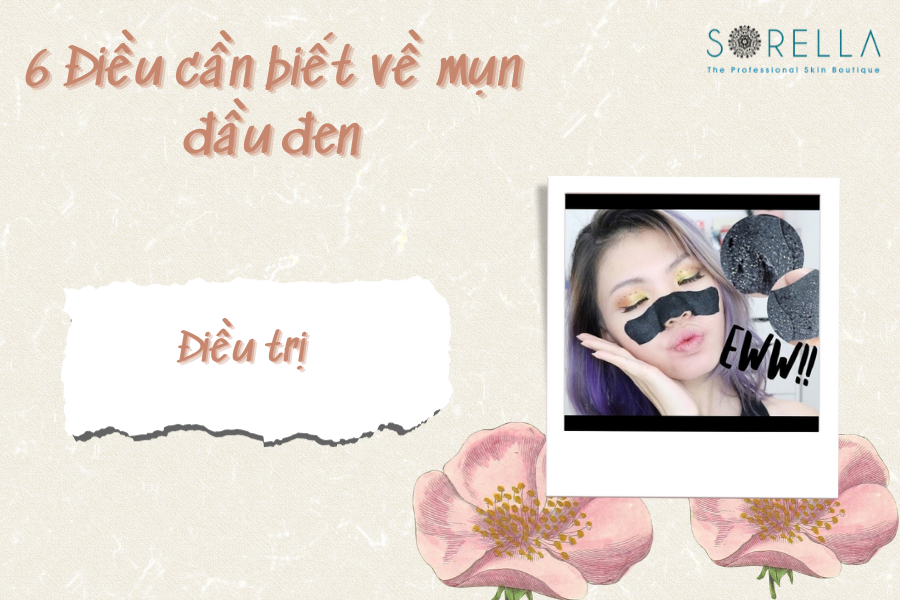 5 Cách điều trị mụn đầu đen
