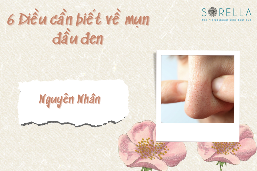 1 Mụn đầu đen là gì? Nguyên nhân