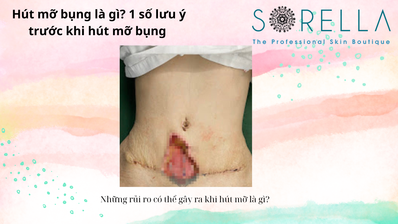 Hút mỡ bụng là gì?