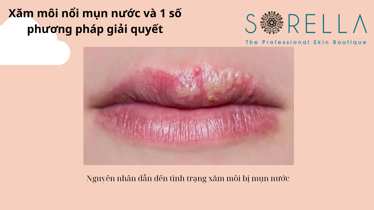 Xăm môi nổi mụn nước