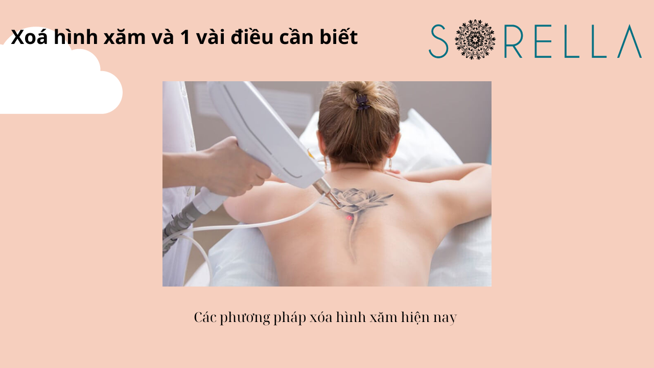 Xóa hình xăm và 1 vài điều cần biết