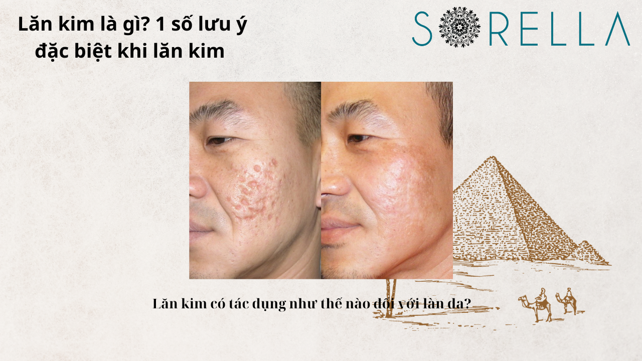Lăn kim là gì?