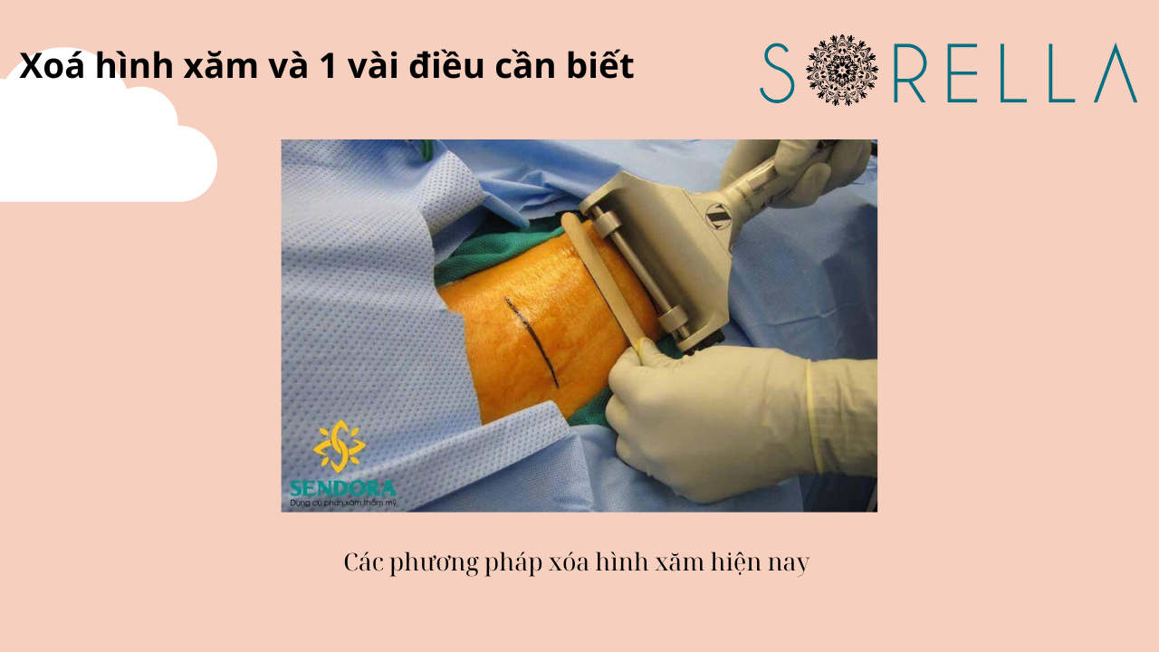 Xóa hình xăm và 1 vài điều cần biết