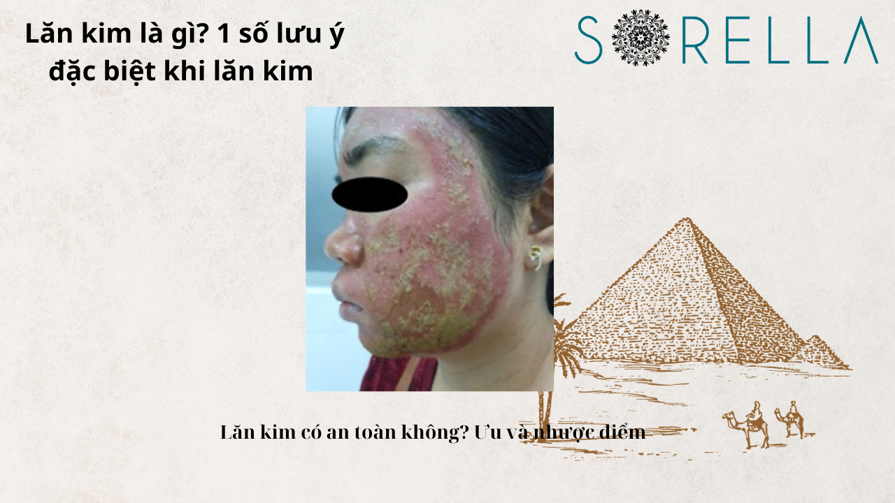 Lăn kim là gì?