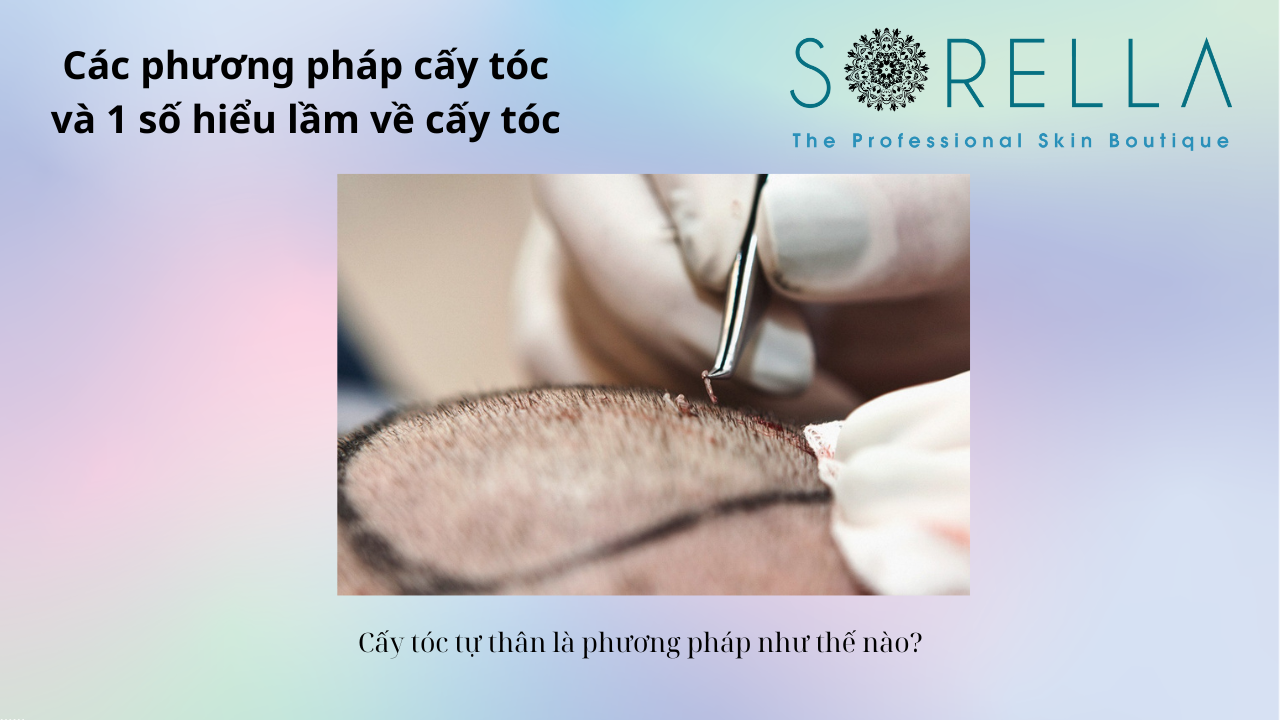 Các phương pháp cấy tóc