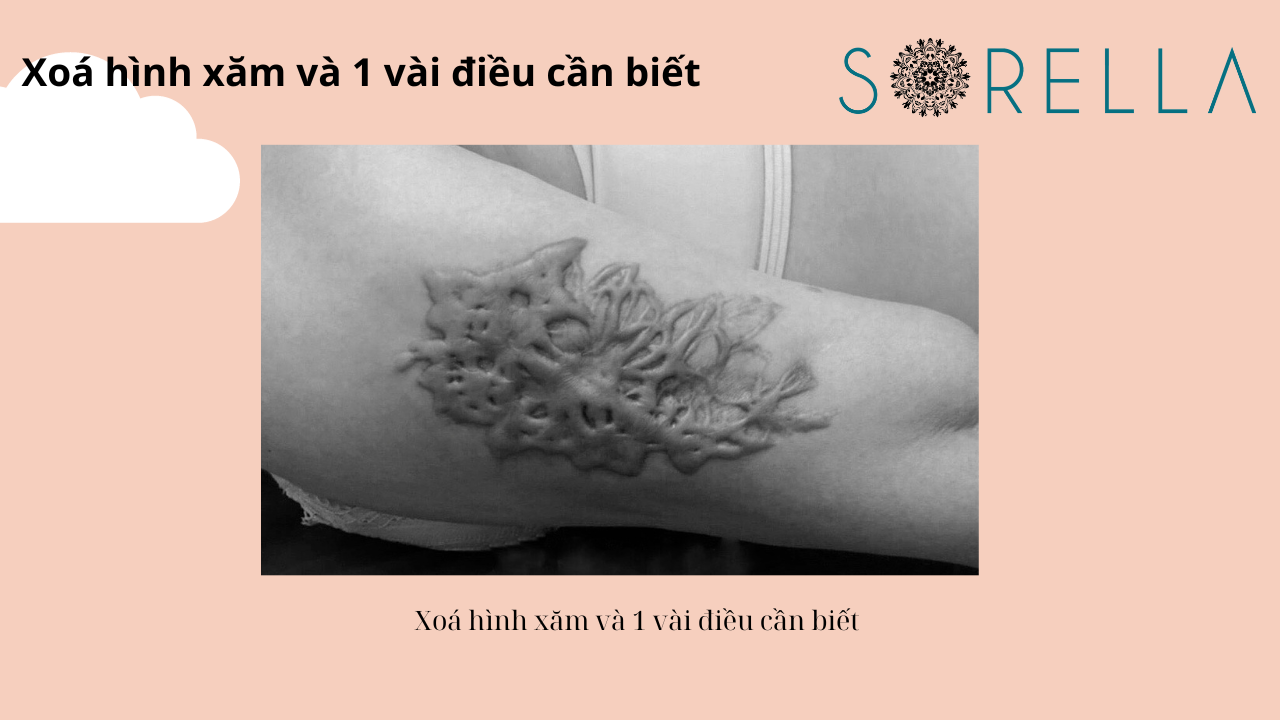 Xóa hình xăm và 1 vài điều cần biết