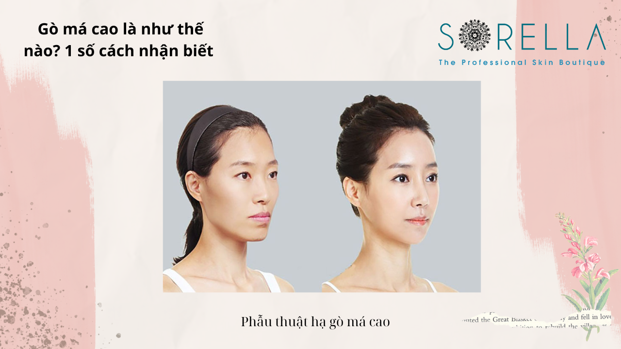 Gò má cao là như thế nào?