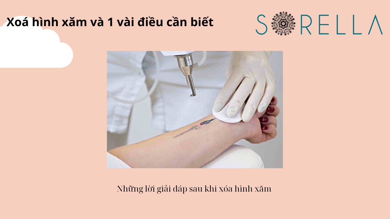 Xóa hình xăm và 1 vài điều cần biết