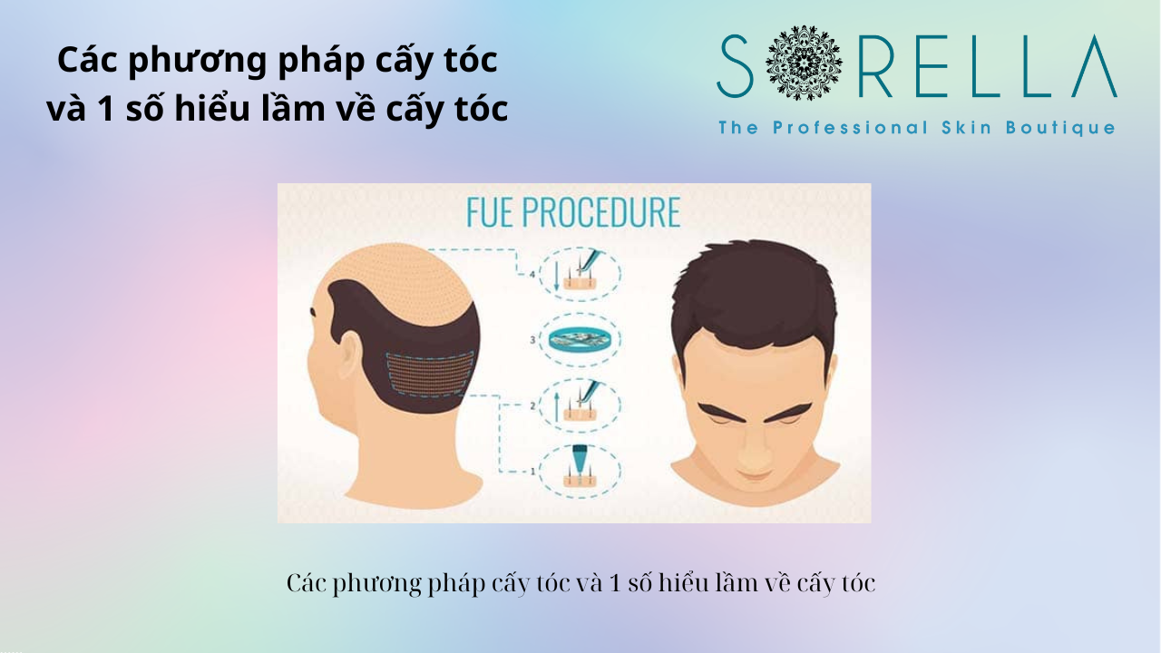 Các phương pháp cấy tóc